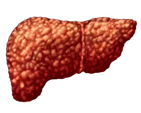 脂肪肝和肝脂肪变性体部分被隔绝在白色作为医疗保健概念消化系统解剖学和重要器官消化功能在3D 例证样式 — 图库照片