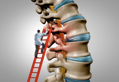 Spine therapy and spinal stenosis medical surgery concept as a degenerative illness surgery in the human vertebrae as a doctor treating and diagnosing the anatomy with 3D illustration elements. clipart