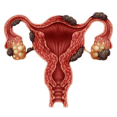 Endometriosis disease anatomy concept as a female infertility condition as a uterus avaries and fallopian tubes with tissue growth with 3D illustration elements. clipart