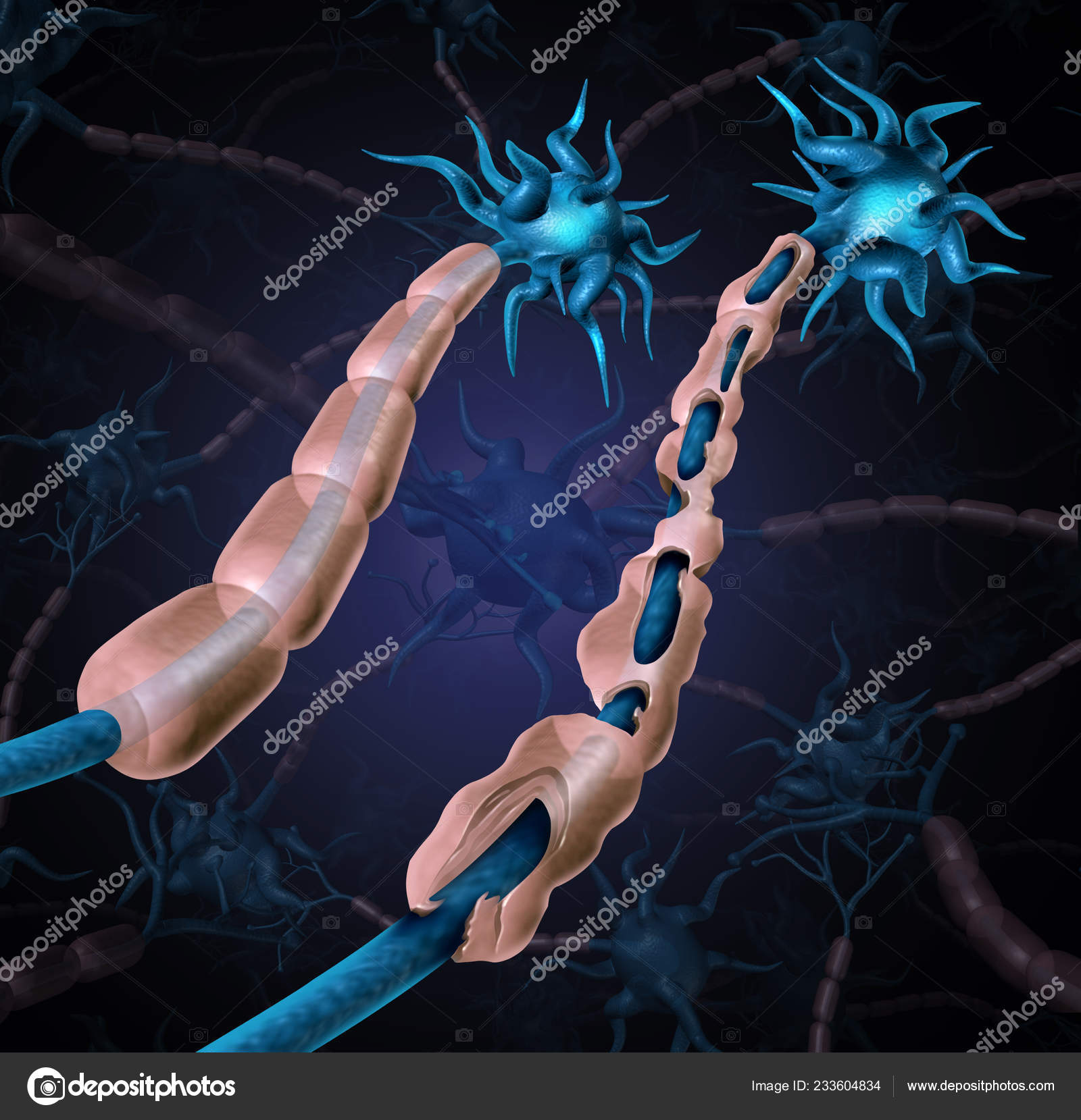 Multiple Sclerosis Damaged Myelin Autoimmune Disease Healthy Nerve Exposed Fibre Stock Photo by ©lightsource 233604834 Multiple Sclerosis Damaged Myelin Autoimmune Disease Healthy Nerve Exposed Fibre Stock Photo by ©lightsource 233604834