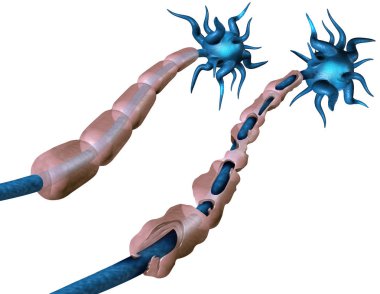 Multiple sclerosis or MS autoimmune disease with healthy nerve and damaged myelin with exposed fibre with scarrred cell sheath loss as a 3D illustration. clipart