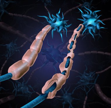 Multiple sclerosis damaged myelin or MS autoimmune disease with healthy nerve with exposed fibre with scarrred cell sheath loss as a 3D illustration. clipart
