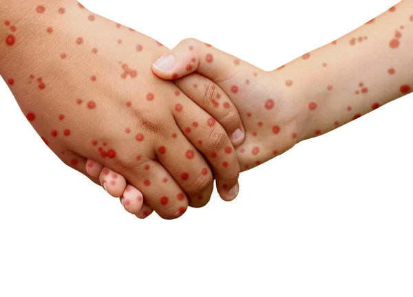 Measles Disease Concept Viral Illness Contagious Chickenpox Skin Rash — Stock Photo, Image