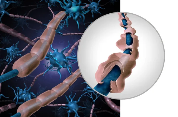Багаторазовий Склероз Мієлінової Хвороби Або Автоімунний Розлад Здоровим Нервом Відкритим — стокове фото