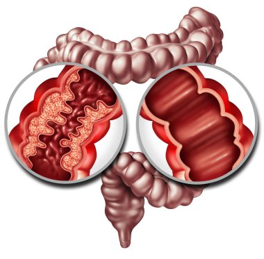 Crohn syndrome disease or crohns illness and healthy colon as a medical concept with a close up of a human intestine with inflammation symptoms causing obstruction as a 3D illustration. clipart