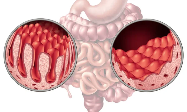 腹腔或腹腔肠疾病解剖医学概念与正常绒毛和损坏的小肠衬里作为消化系统的自身免疫性疾病与结肠和胃作为3D — 图库照片