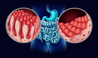 Celiac or coeliac disease as an intestine anatomy medical concept with normal villi and damaged small bowel lining as an autoimmune disorder of the digestion system with colon and stomach as a 3D illustration. clipart