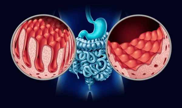 Celiac Coeliac Disease Intestine Anatomy Medical Concept Normal Villi Damaged — Stock Photo, Image