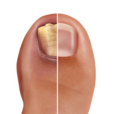 Fungal nail infection and onychomycosisor tinea unguium as an infected foot toenail or toe nail with damaged unhealthy and healthy human anatomy in a 3D illustration style. clipart