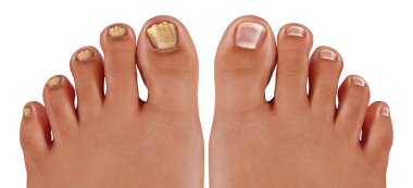 Onychomycosis and fungal nail infection or tinea unguium as an infected foot toenail or toe nail with damaged unhealthy and healthy human anatomy in a 3D illustration style. clipart