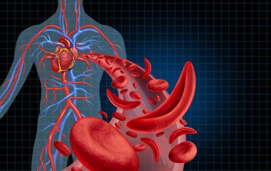 Sickle cell cardiovascular heart blood circulation and anemia as a disease with normal and abnormal hemoglobin in a human artery anatomy as a medical illustration concept with 3D illustration elements. clipart