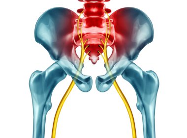 Sciatica pain symptoms and diagnosis medical concept as a disease causing physical problems with 3D illustration elements on a white background. clipart