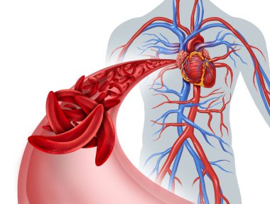 Sickle cell heart circulation blockage and anemia as a disease with normal and abnormal hemoglobin in a human artery anatomy with heart cardiovascular medical illustration concept with 3D illustration elements. clipart