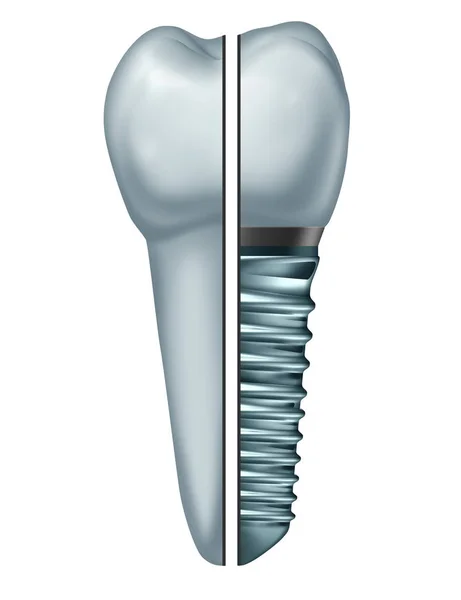 歯科インプラント歯や骨内の歯矯正クラウン Abutement イラストレーションとして矯正歯科外科オブジェクトとして白い背景に分離された金属のネジと補綴の比較 — ストック写真