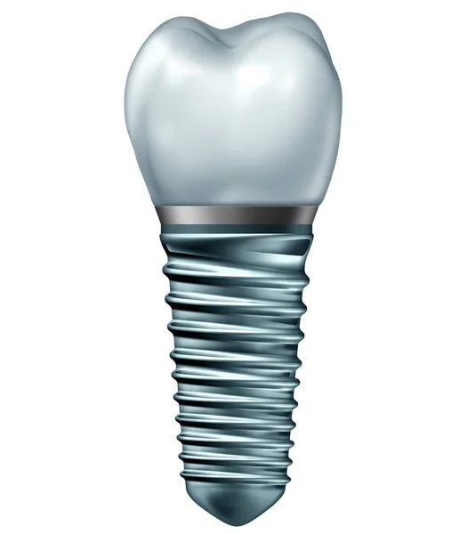 Implante Dentário Conceito Prótese Dentária Endosseada Com Pilar Ortodôntico Coroa — Fotografia de Stock