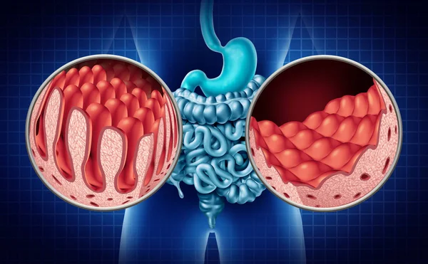 Enfermedad del intestino celíaco — Foto de Stock