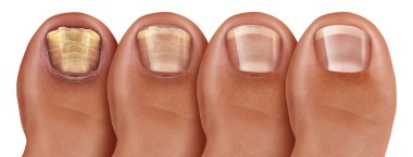Fungal Nail Infection Recovery clipart