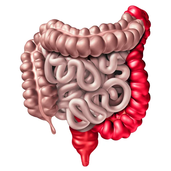 Colitis ulcerosa — Foto de Stock