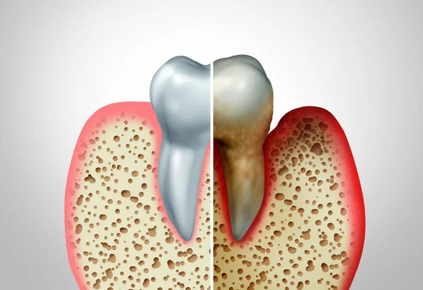 牙龈疾病 — 图库照片