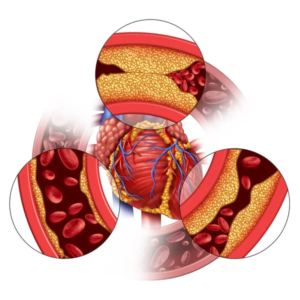 心脏动脉疾病和冠心病的医学概念 即逐渐形成斑块 导致动脉阻塞和动脉粥样硬化 是具有三维示踪元素的人体解剖学 — 图库照片