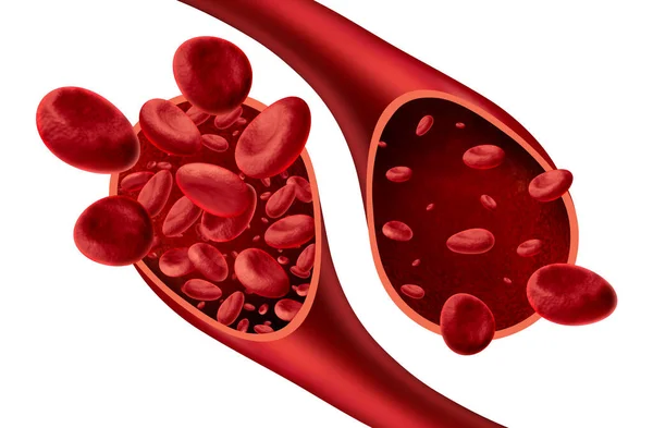 Концепція Медичної Діаграми Анемії Анемії Нормальна Аномальна Кількість Клітин Крові — стокове фото