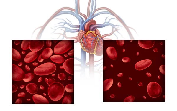 Концепция Медицинской Диаграммы Анемии Анемии Нормальное Аномальное Количество Клеток Крови — стоковое фото