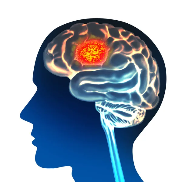 Koncepcja Anatomii Raka Mózgu Symbol Nowotworu Złośliwego Jako Części Ciała — Zdjęcie stockowe