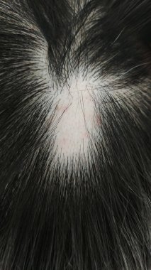 Alopesi areata Saç Güz sorunu