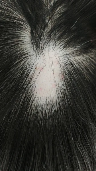 Alopecia Areata Caída Del Cabello Problema —  Fotos de Stock