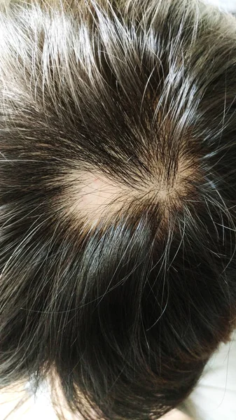 Alopecia Areata Queda Cabelo Problema — Fotografia de Stock