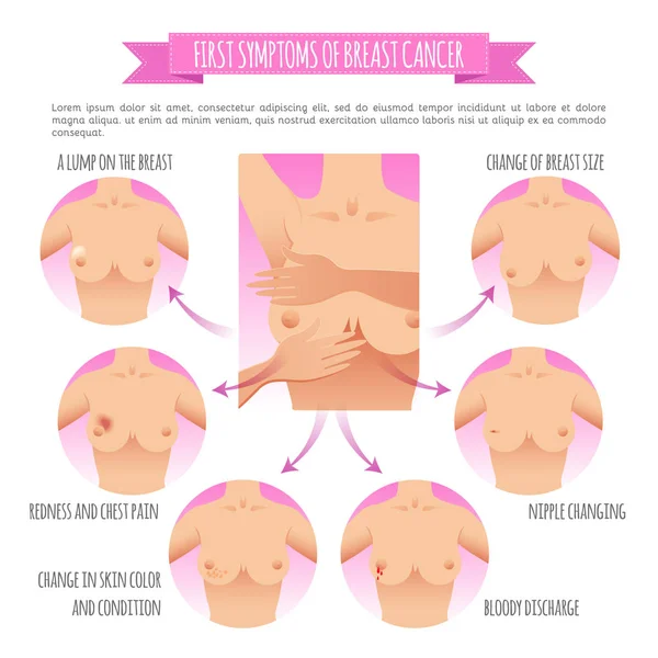 Καρκίνος του μαστού ευαισθητοποίηση φορέα infographic — Διανυσματικό Αρχείο