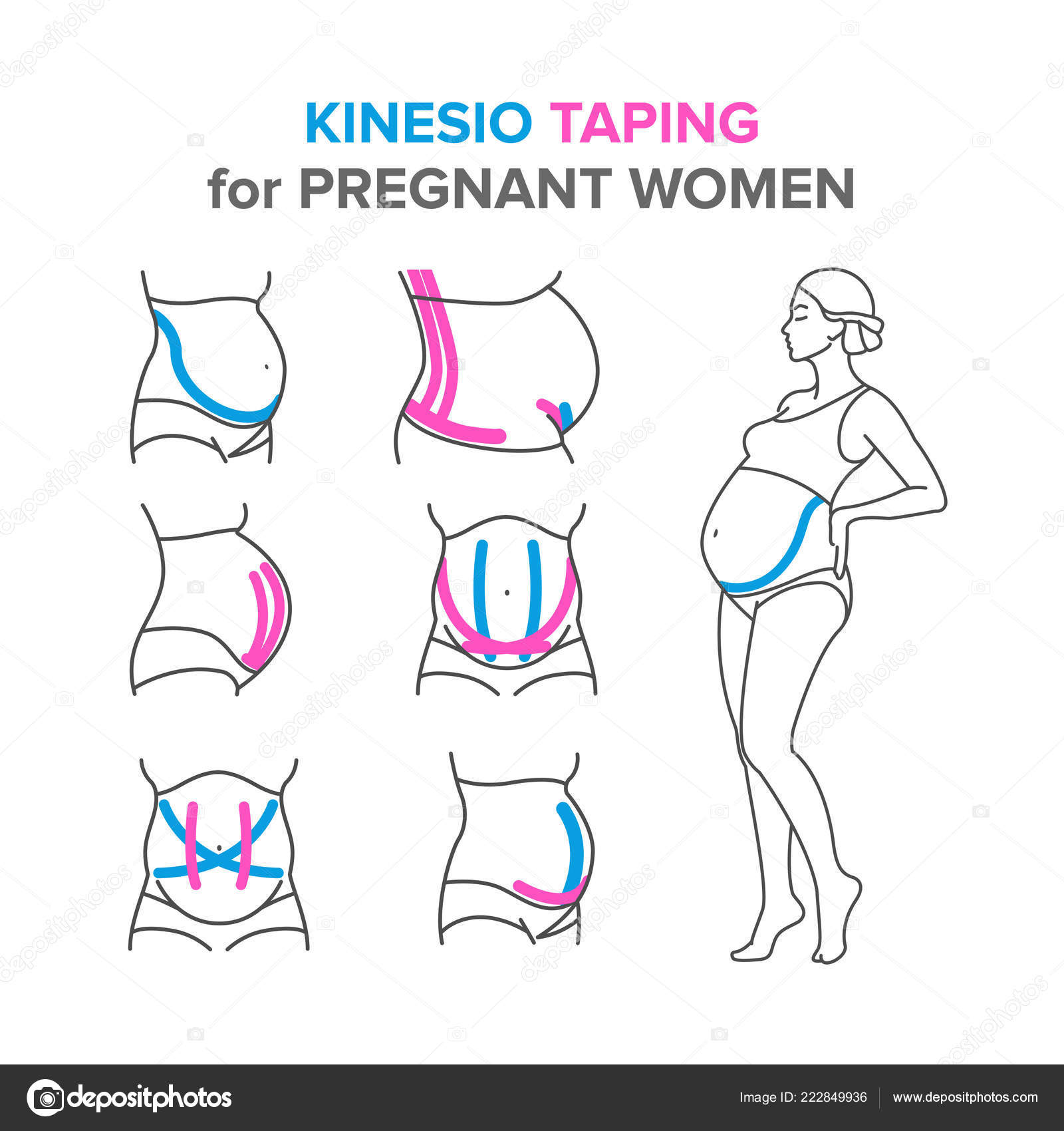 Kinesiotaping in pregnancy & postpartum ❘ blog by Gravidamiga