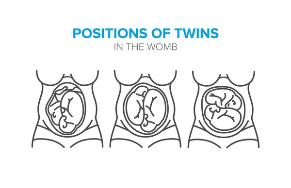 자 궁에 쌍둥이의 위치 — 스톡 벡터