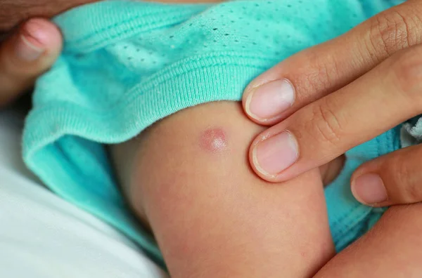 Bacille Calmette Guerin Vaccine Bcg Blister Baby Shoulder — стоковое фото