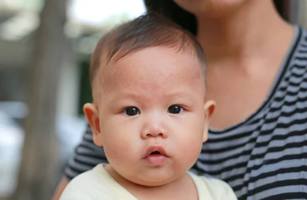 Erupciones Faciales Del Bebé Dermatitis — Foto de Stock