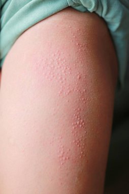 Yakın çekim Kadın bacağında alerjik döküntü dermatit egzama.