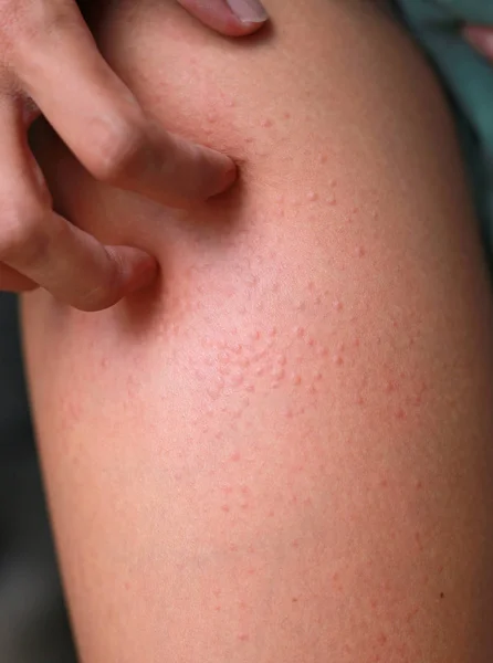 Dermatite Allergique Cutanée Eczéma Cutané Grattage Des Mains — Photo