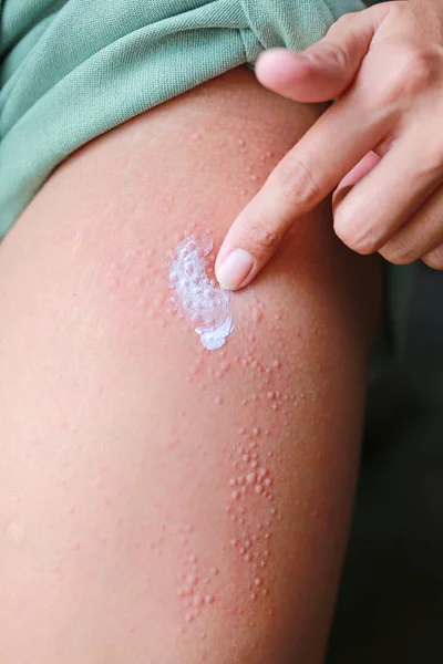 Mano Aplicar Ungüento Dermatitis Erupción Alérgica Piel Concepto Cuidado Piel — Foto de Stock