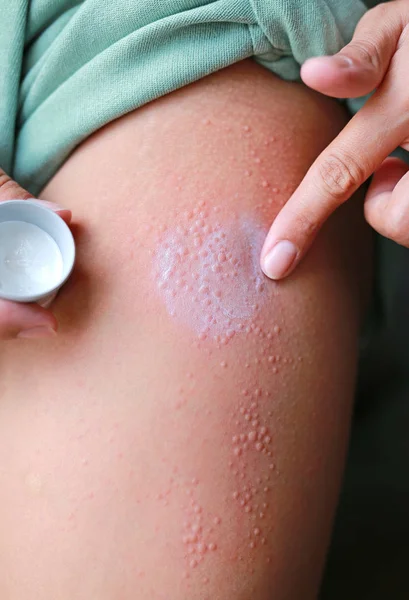 Mão Aplicando Pomada Dermatite Pele Erupção Cutânea Alérgica Conceito Cuidados — Fotografia de Stock