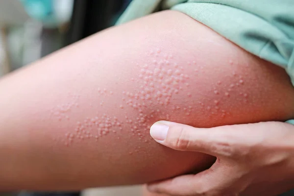 Primer Plano Dermatitis Alérgica Cutánea Eccema Pierna Mujer — Foto de Stock