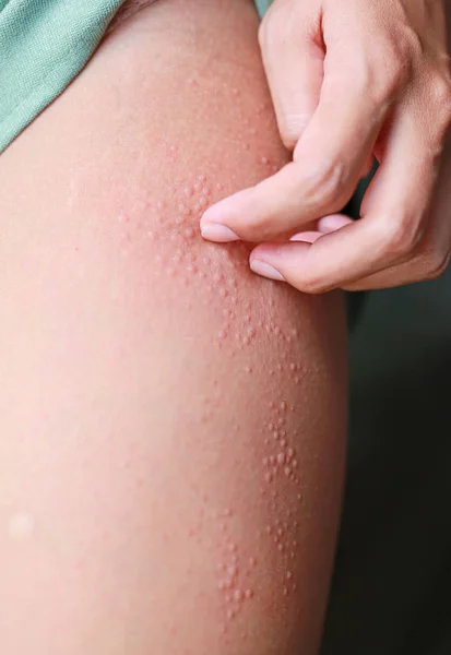 Erupción Alérgica Dermatitis Eccema Piel Rascándose Mano — Foto de Stock