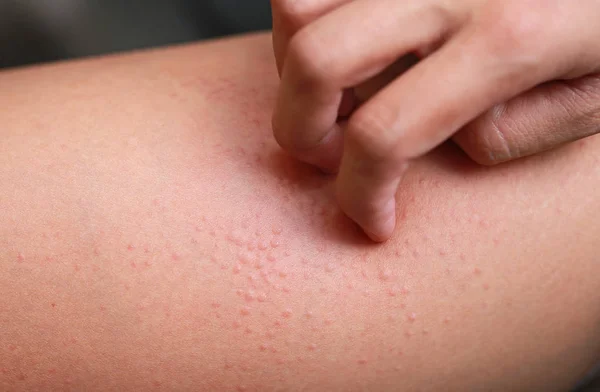 Rascando Mano Erupción Alérgica Dermatitis Eccema Piel — Foto de Stock