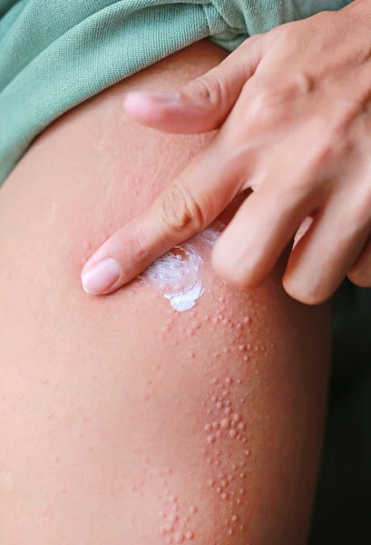 Woman hand apply medicine on the rash.