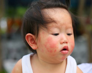 Yakın çekim yüz bebek döküntüleri, dermatit, tam, ama yine de iyi.