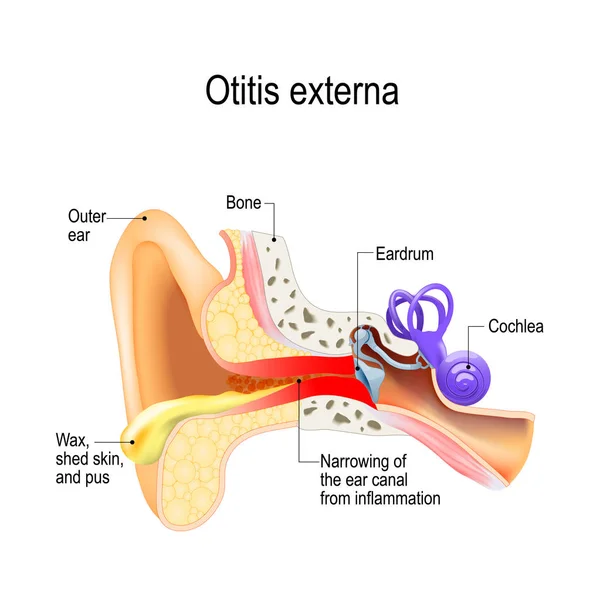 La oreja de nadador. Otitis externa — Archivo Imágenes Vectoriales