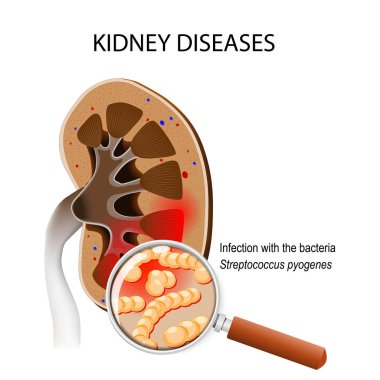 Kidneys disease. Human kidney with bacterial infection. Close-up bacteria Streptococcus pyogenes that cause illness. vector illustration for medical, educational and science use clipart
