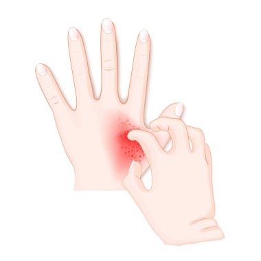 kaşıntı. İnsan'ın elle dermatit. Vektör çizim biyoloji, bilimsel ve tıbbi kullanım için.