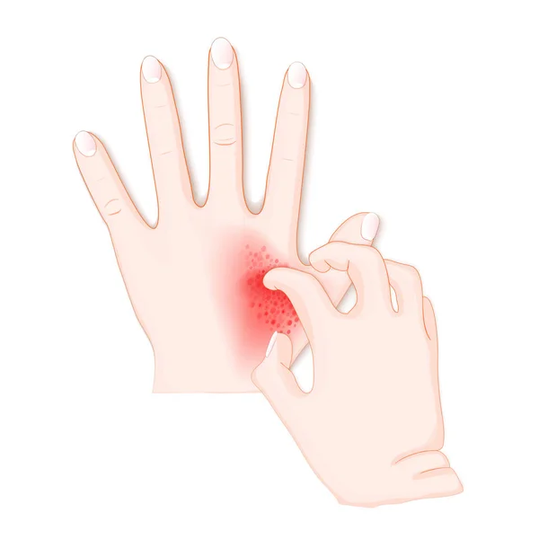 Jeuk Menselijke Handen Met Dermatitis Vectorillustratie Voor Biologie Wetenschappelijk Medisch — Stockvector