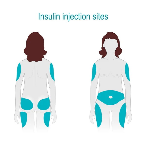 Lugares Inyección Insulina Diabetes Mellitus Cuerpo Femenino Vista Frontal Trasera — Vector de stock