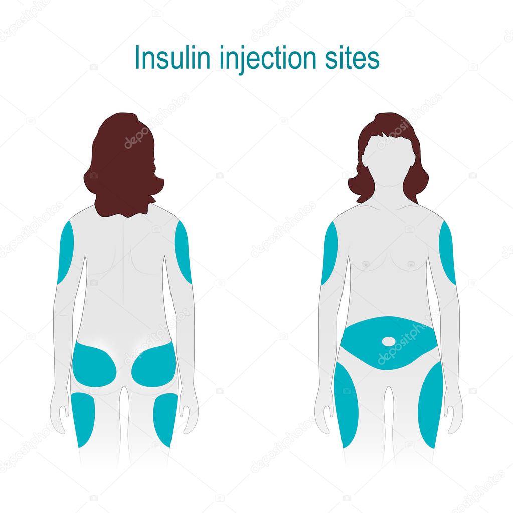 Insulin injection sites. Diabetes mellitus. Female body front and back view wit